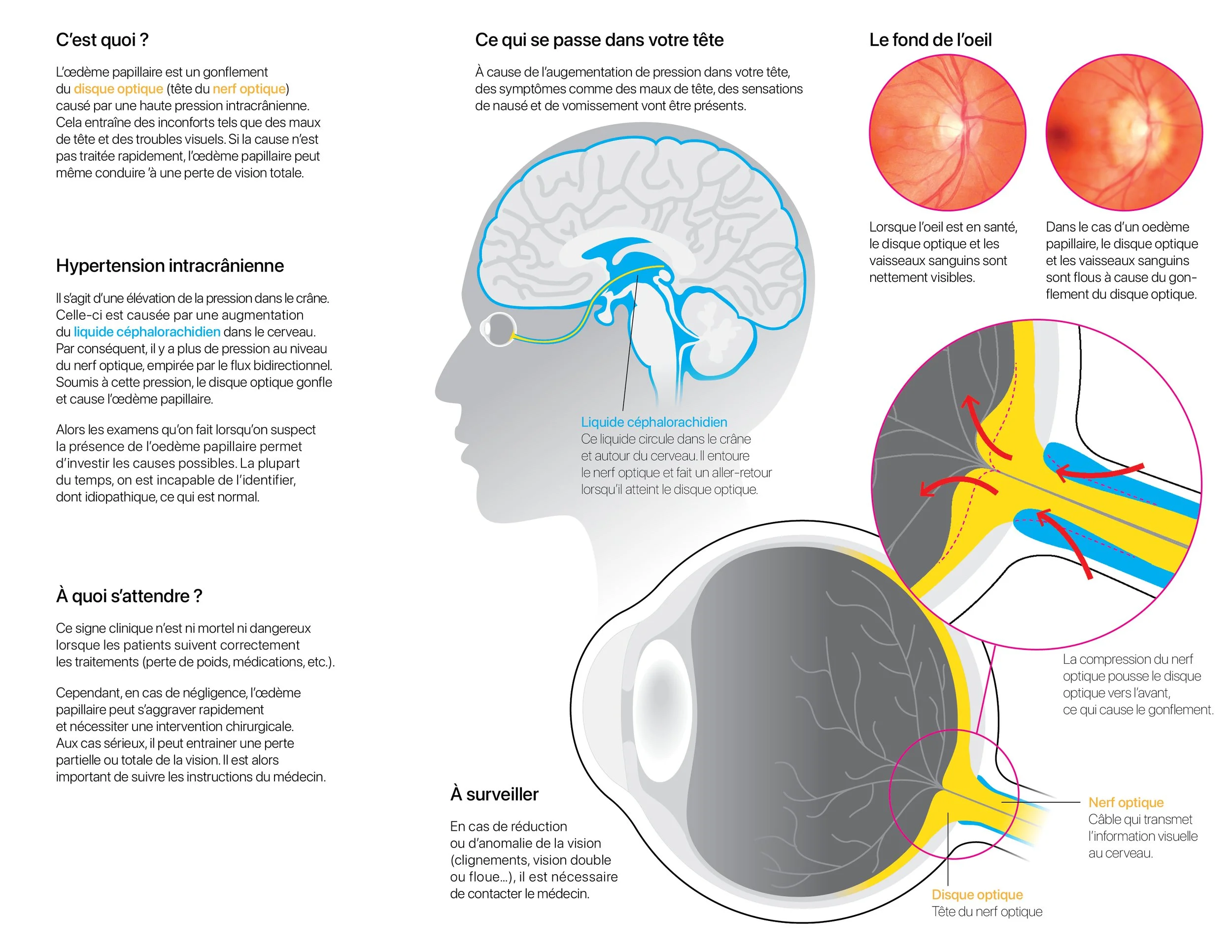 oedème papillaire2.jpg