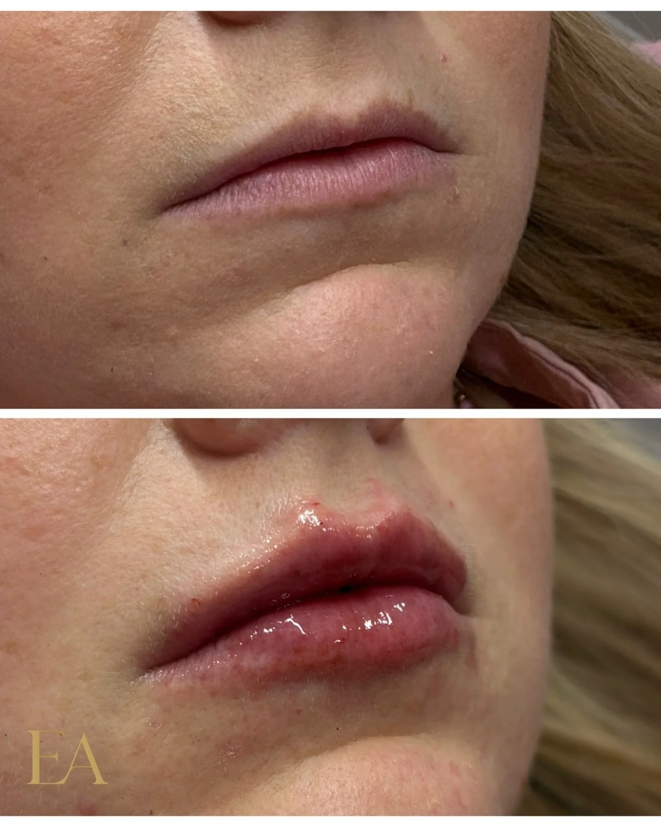 Enhancement, not transformation.

These natural-looking lips are all about soft volume, symmetry, and confidence. 💫

All Dermal Filler is 20% off until Nov 30th! ✨

📍ELEVATED AESTHETICS 
📍 611 Dutchmans Ln Ste B2 Easton MD, 21601
📲443-216-9332 
?