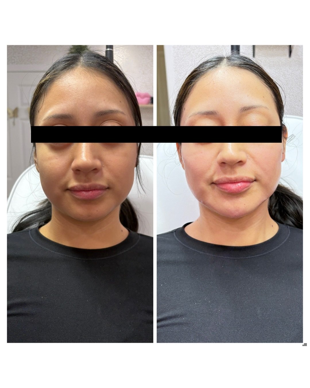Facial Balancing with a focus on Cheeks &amp; Chin for this beauty! ✨ 

3 Syringes spread out in the face for Natural Elevation that enhanced your natural features! ✨ 

Revanesse Versa+ ALWAYS! 
- Minimal Swelling
- Soft , Smooth 
- Moves with you 

