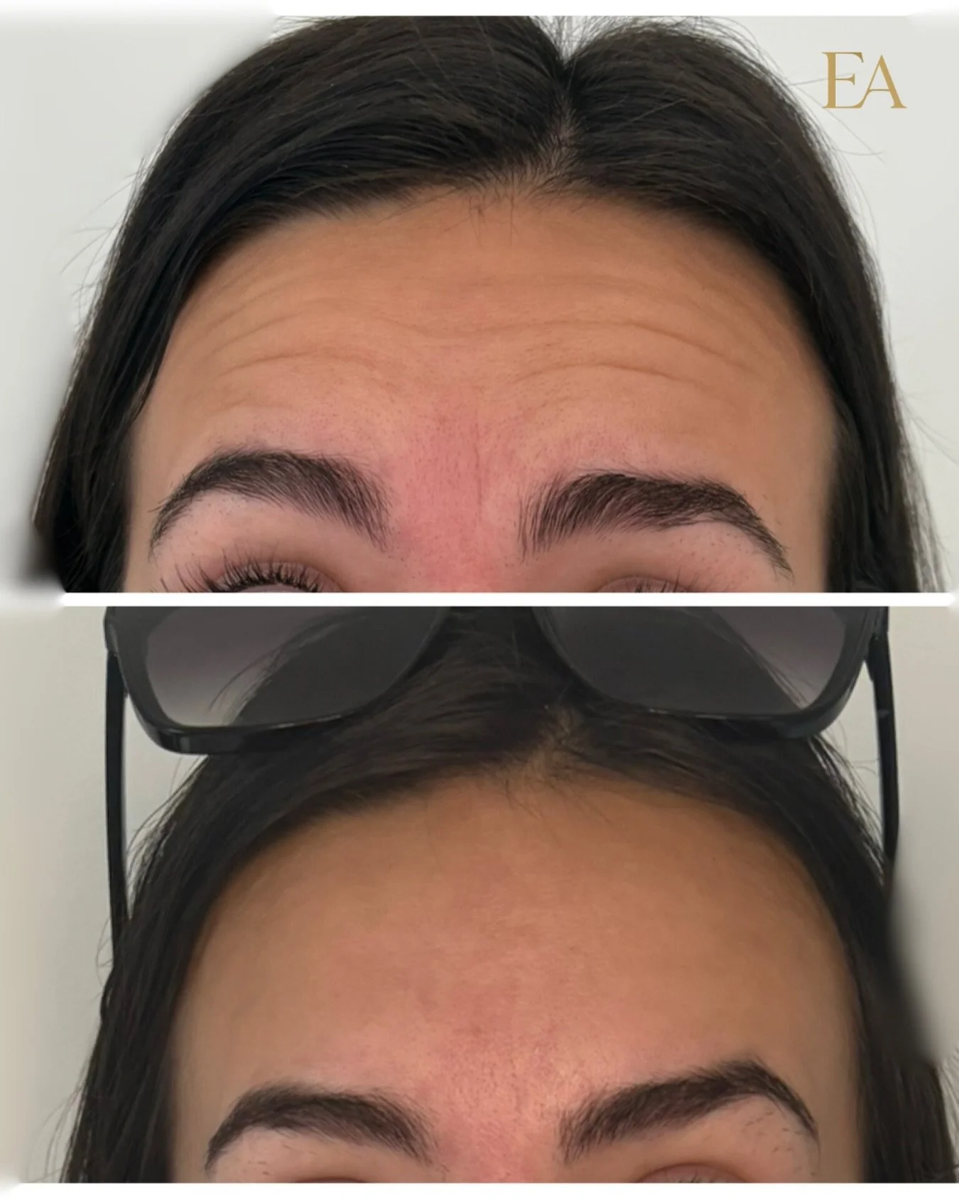 Smooth, refined, elevated.

Forehead Botox is one of the most effortless ways to soften fine lines and create a refreshed, naturally polished look. ✨

Experience results the Elevated way with our Elevated Memberships &mdash; designed to make consiste