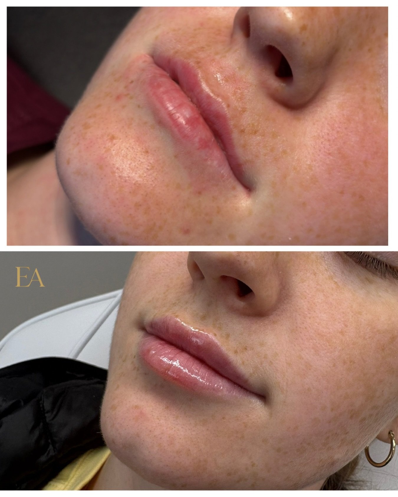 The Perfect Pout 💋👏🏼

This patient was treated with Revanesse Lips+ , Two sessions, 2-3 weeks apart to allow the lips to heal! 

Proof to Trust the Process! 

Healing time is extremely important &amp; looks different for everyone! 

Want your perf