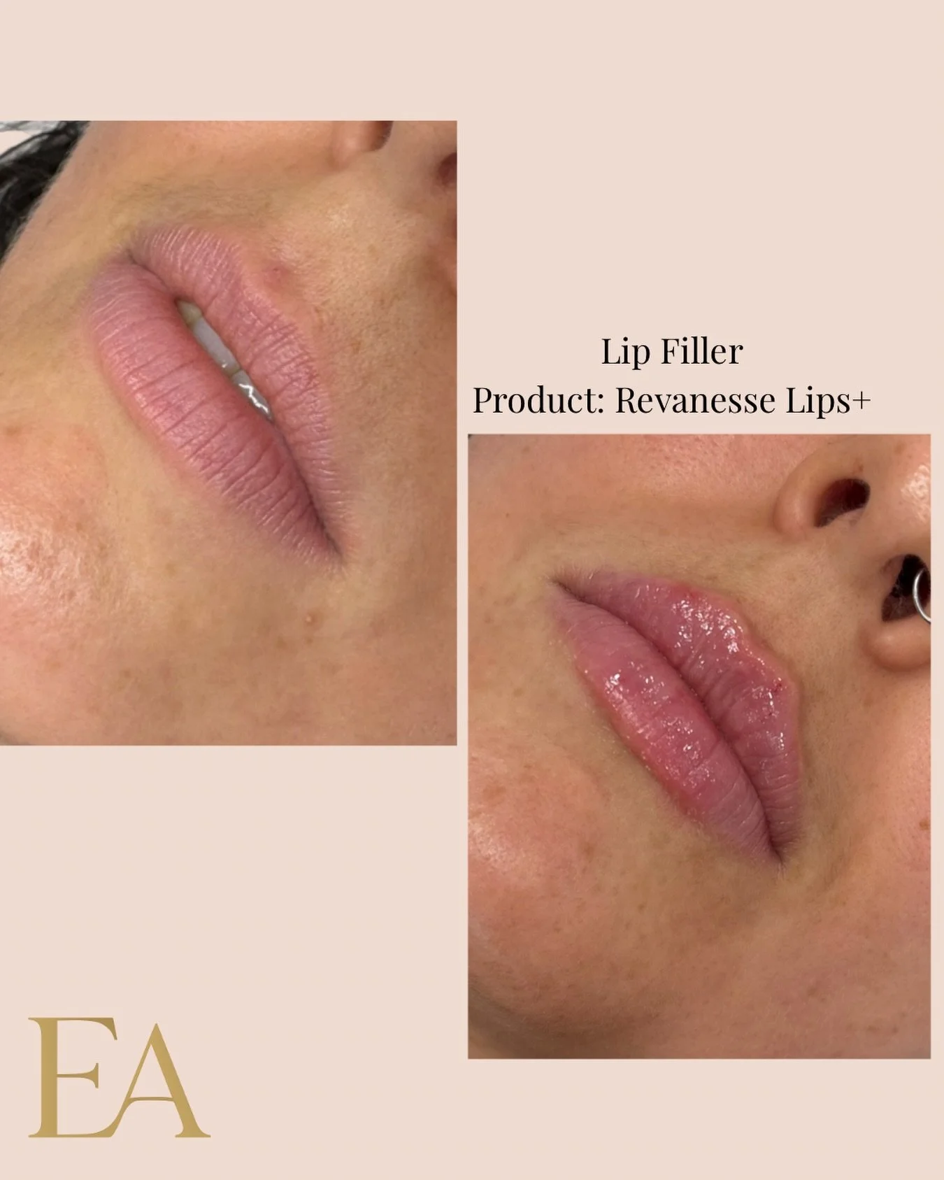 Subtle enhancement, beautifully balanced ✨
This lip filler treatment was designed to enhance shape, restore volume, and maintain a natural look that stays perfectly proportionate to the entire face.

No overfilling &mdash; just soft definition, impro