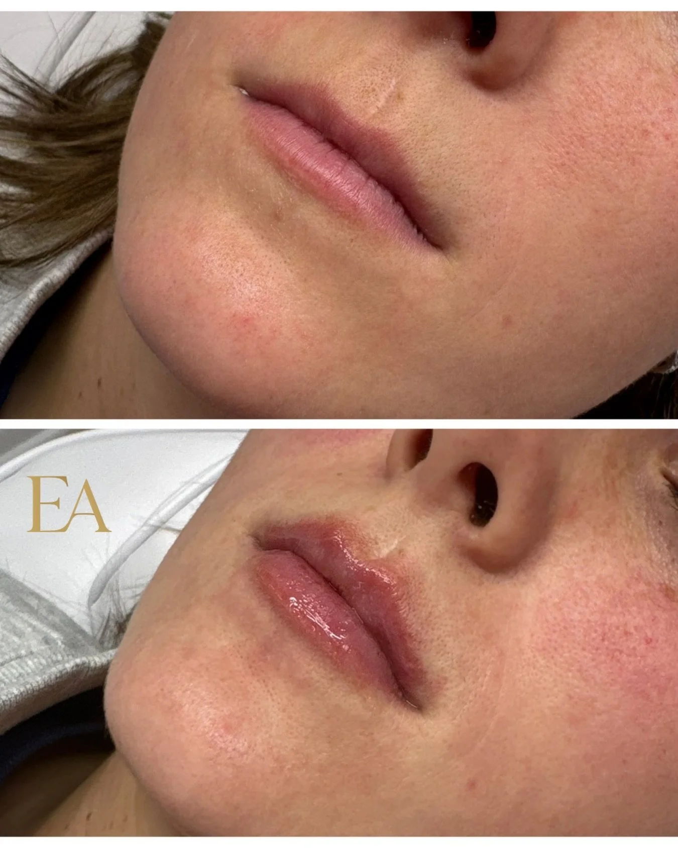 Did Santa bring you your dream lips? 👄 

If not it&rsquo;s okay! We can help you! ✨

Your dream lips are made to happen at Elevated Aesthetics , this was Session #2 for this gorgeous girl! We&rsquo;re slowly building them one session at a time to ac