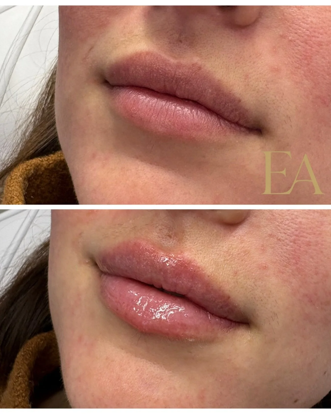 Little Lip Filler touch up for our Marketing Queen 👄 

Results from this treatment are soft , smooth , naturally plump lips ✨ 

📍ELEVATED AESTHETICS 
📍 611 Dutchmans Ln Ste B2 Easton MD, 21601
📲443-216-9332 
📲 @elevated.aestheticsmd
💉 @Injector