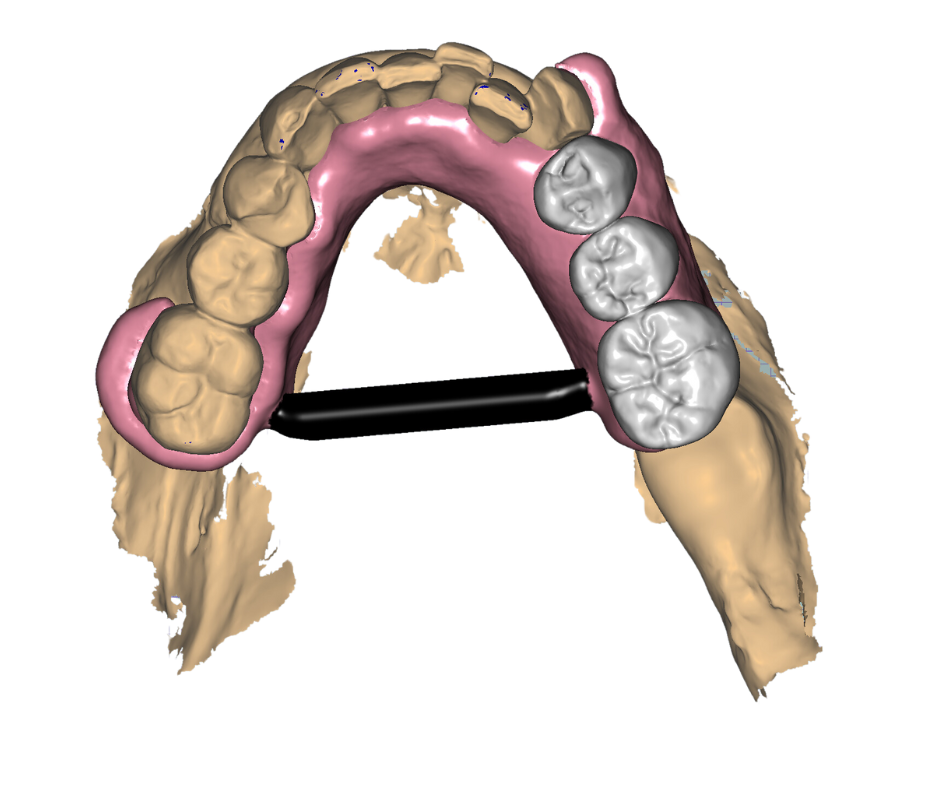 3D digital model of a dental arch with several molars, some with dental restorations, and gum tissue, viewed from above.