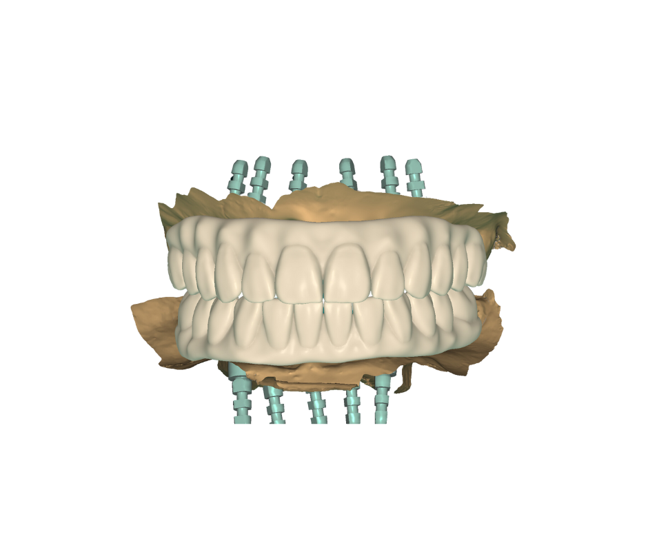 A digital dental model showing upper and lower teeth with dental implants secured into the jawbone.