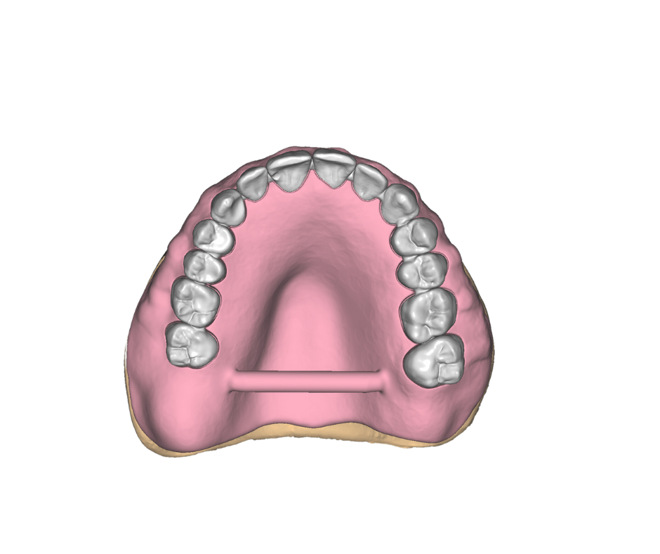 A 3D rendered model of the upper jaw showing teeth and gum tissue, with a horizontal bar across the palate.