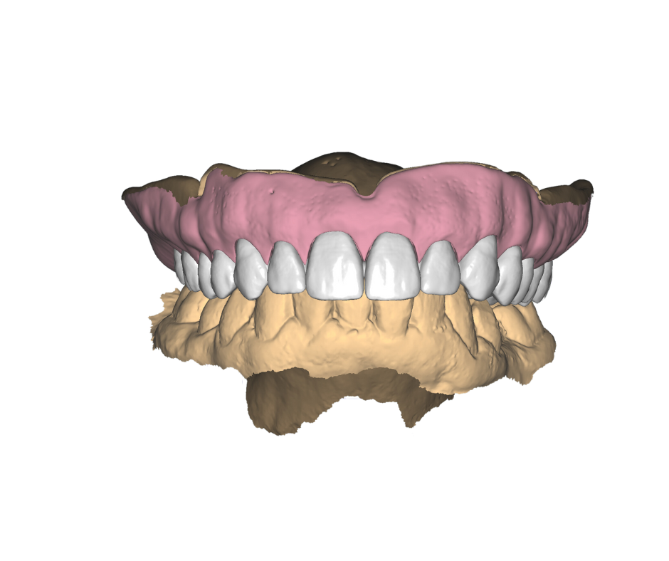 3D digital model of human teeth and gums with the upper pink gum line and lower beige jawbone.
