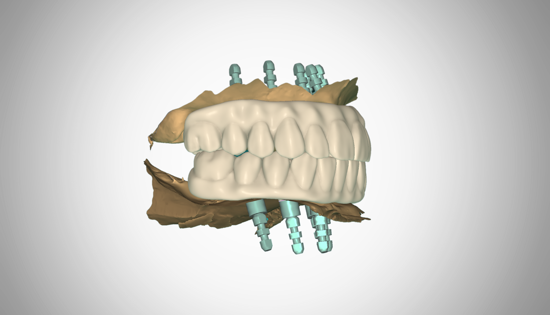 3D rendering of a dental surgical guide with dental implants and teeth.