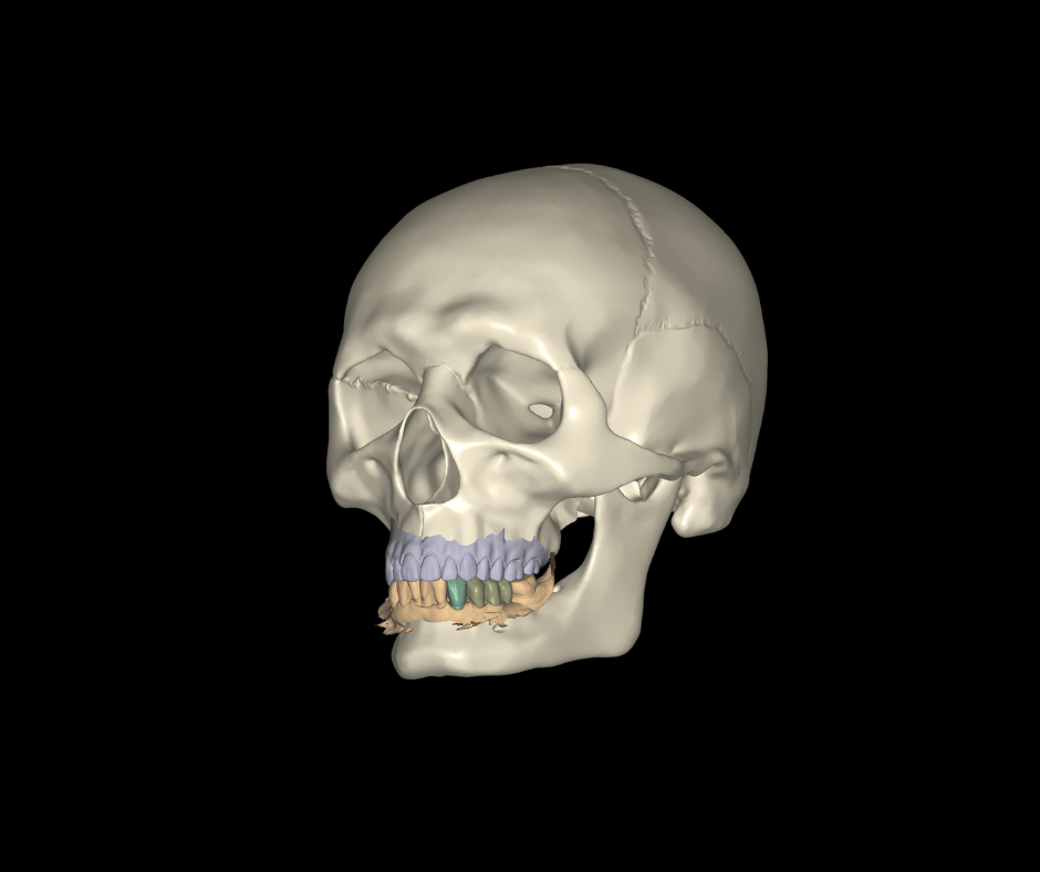 3D model of a human skull with some teeth colored in blue, green, and yellow.