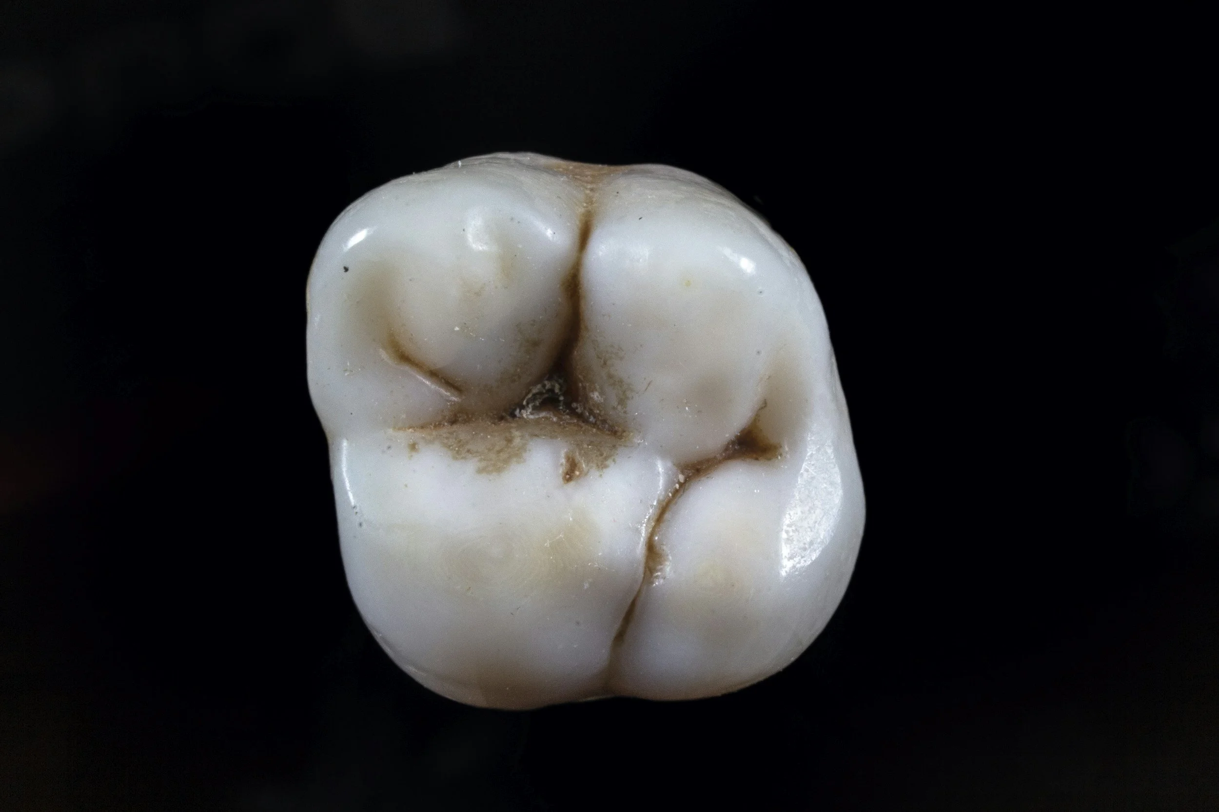 Extraction in Oralville