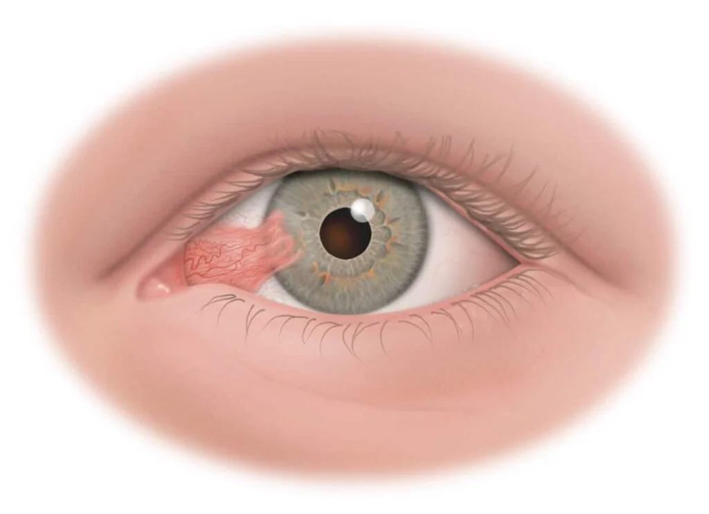 Pterygium "Surfer's Eye" Surgery