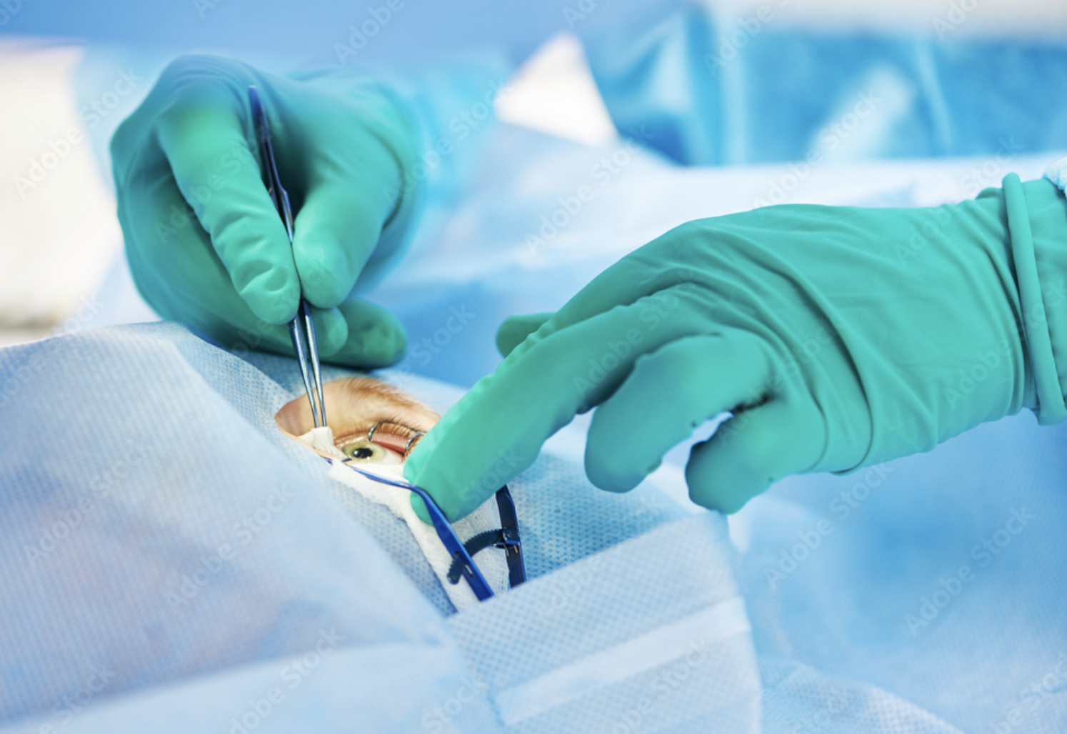 Filtering Glaucoma Surgery