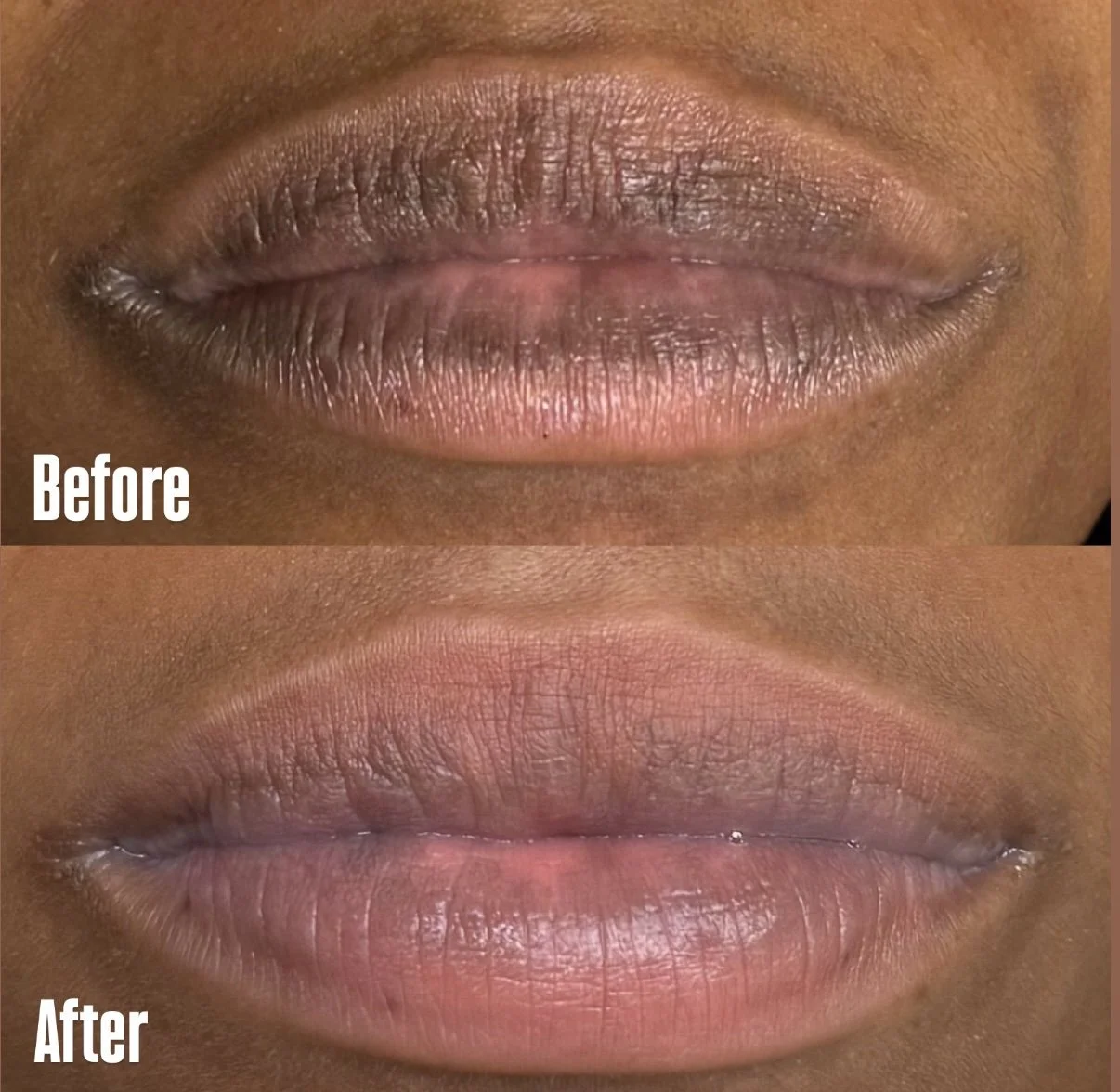 Dark Lip Neutralization