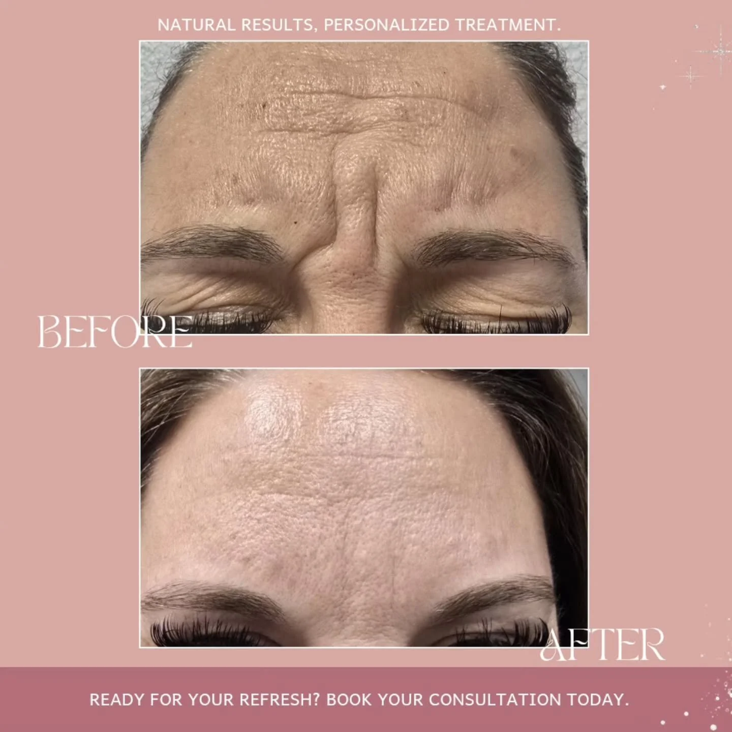 Real results that still look like you. ✨

One of the most common concerns I hear is: "I want softer lines, but I don't want to look frozen."

This transformation is a great example of what's possible with a personalized treatment plan. By r