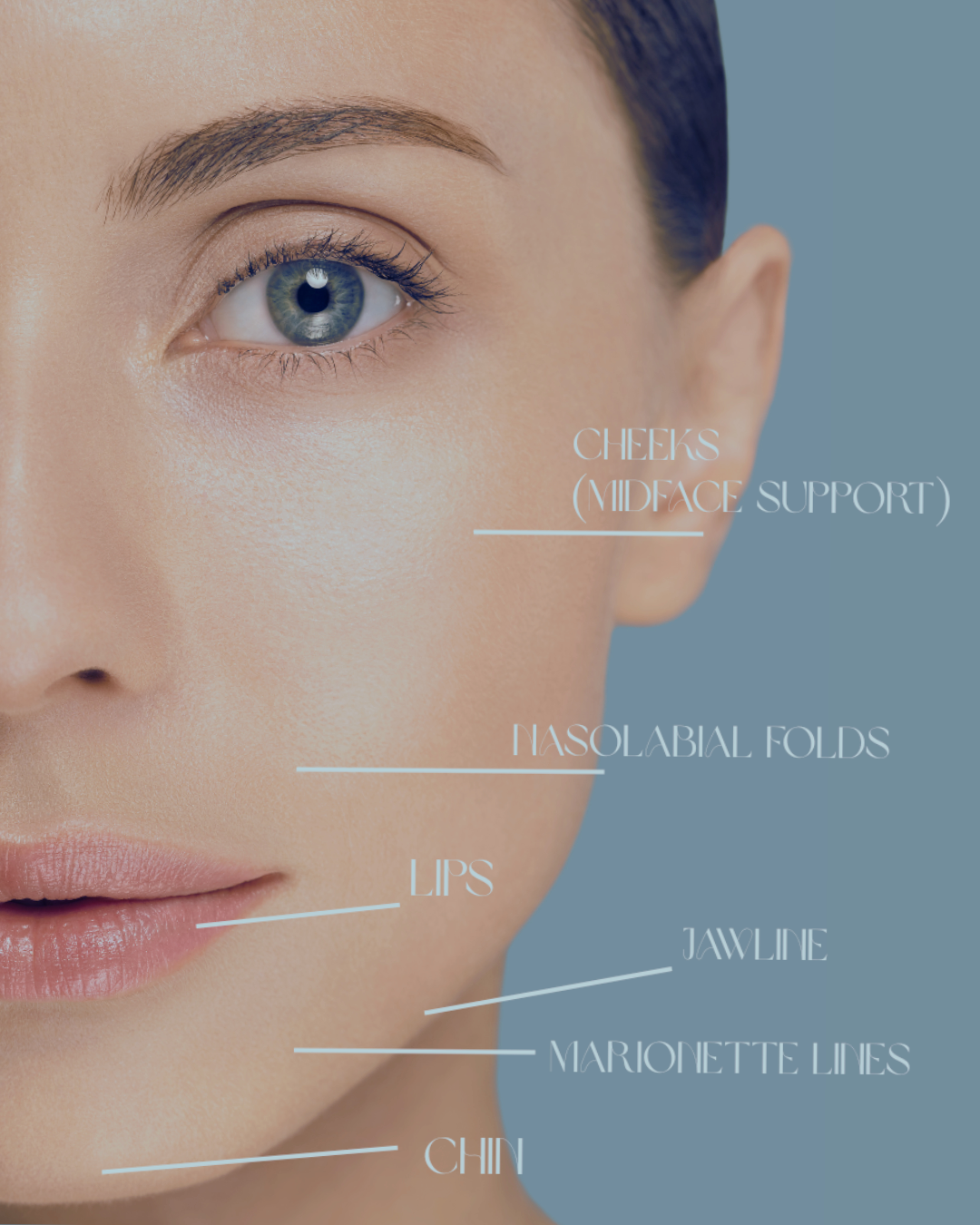 Close-up of a woman's face with labels marking different facial features: cheeks (midface support), nasolabial folds, lips, jawline, and chin. The background is a soft blue.