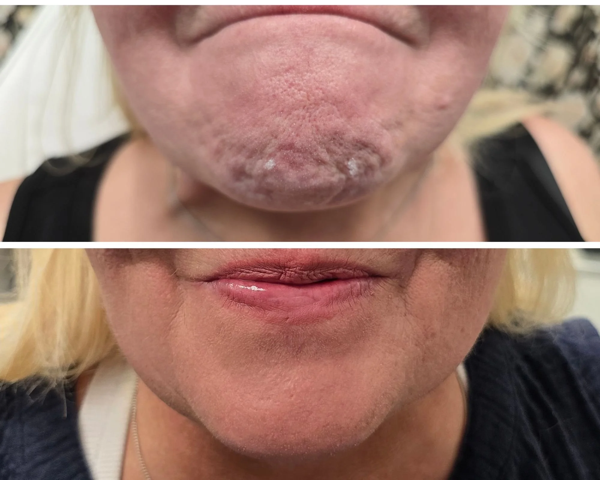 Chin Tox
Softened chin dimpling for a smoother, more refined lower face.