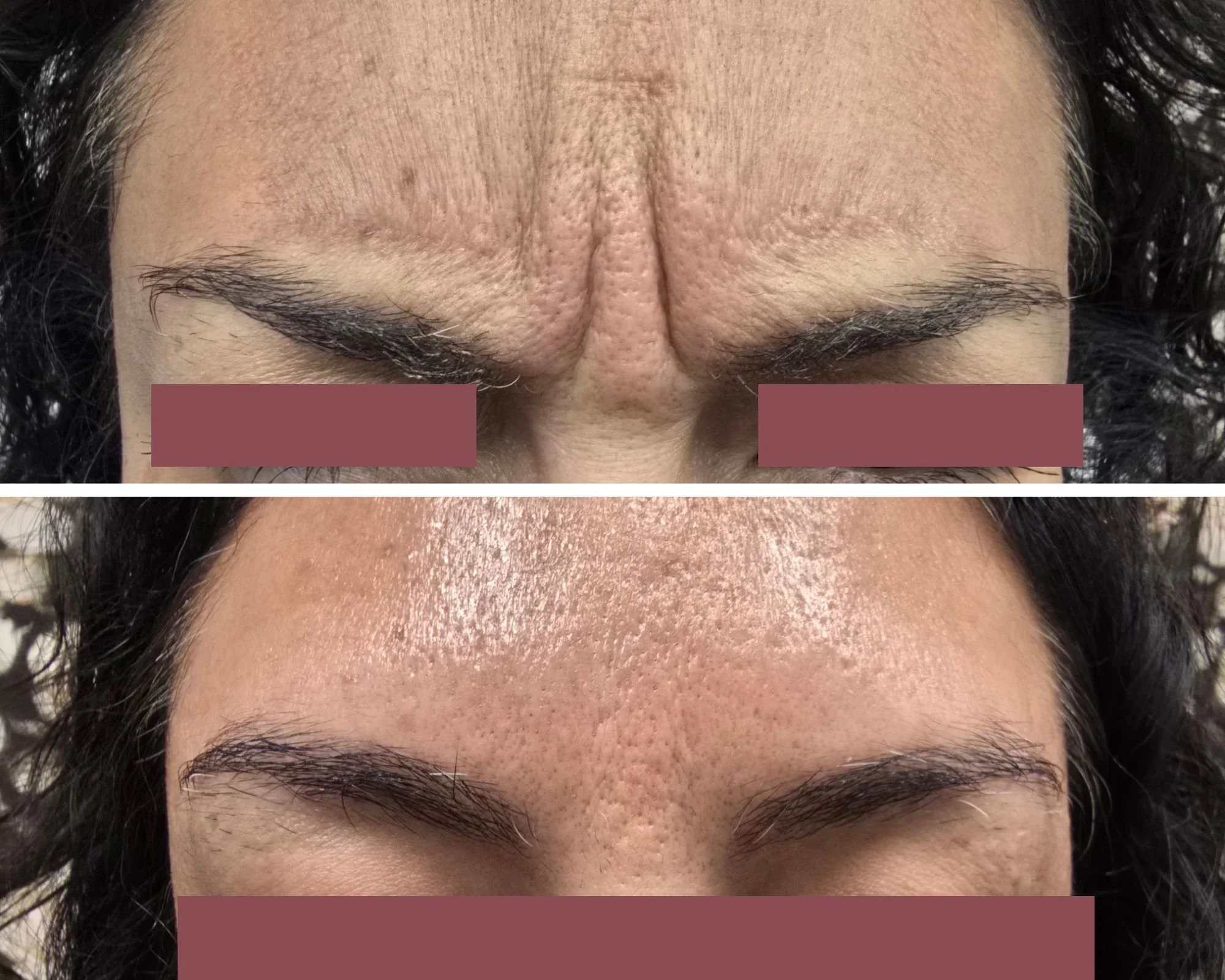 Glabellar Tox (“11s”)
Targeted treatment to soften frown lines between the brows while maintaining natural expression.