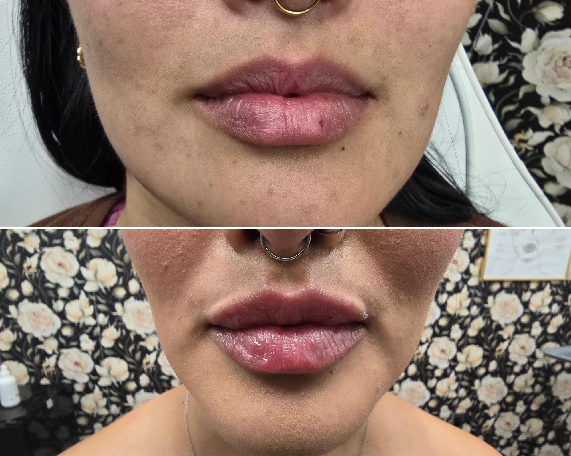 LIp filler