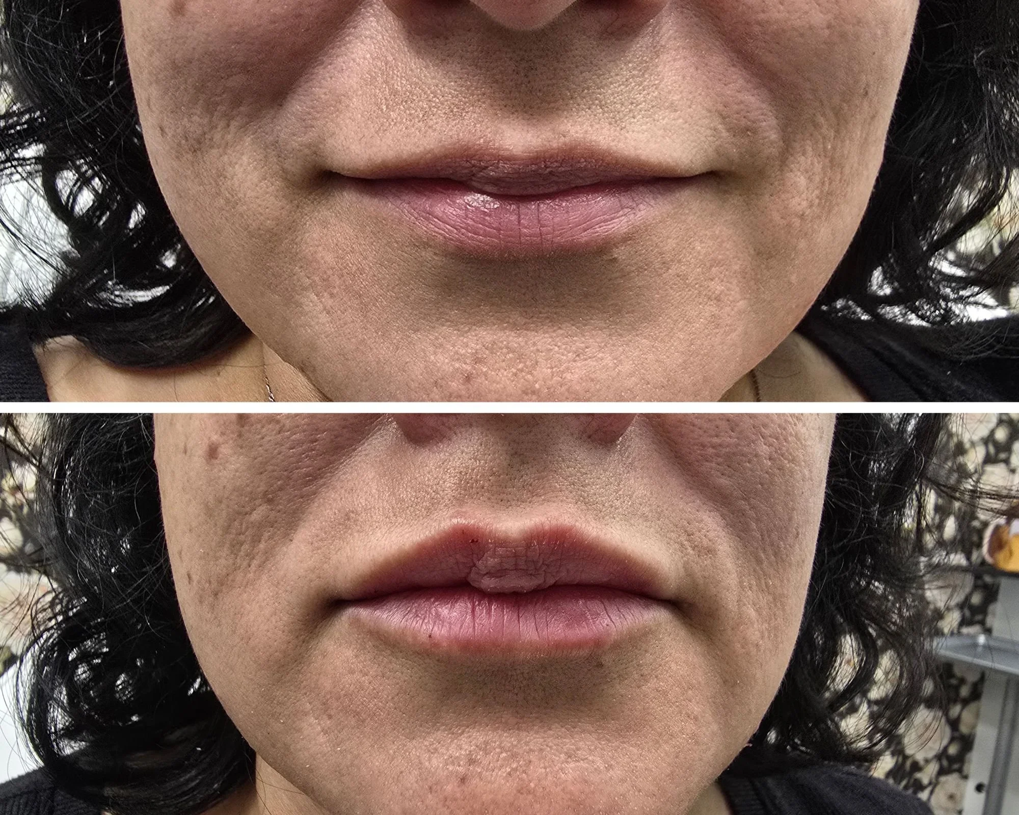 Lip filler; Even out filler