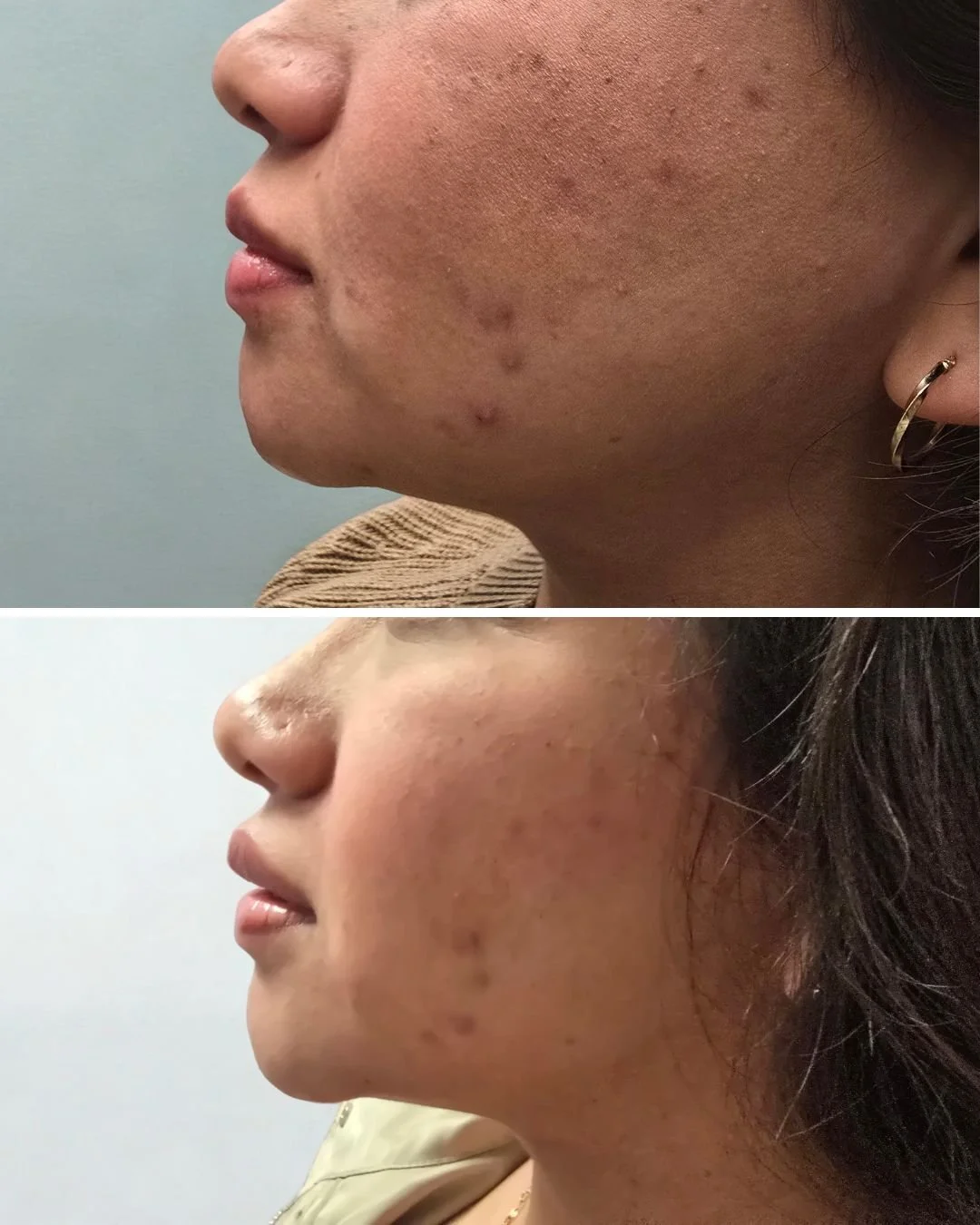 Lower Face Balancing
Chin filler, jawline tox, lip flip, and nose contour with tox for improved profile balance.