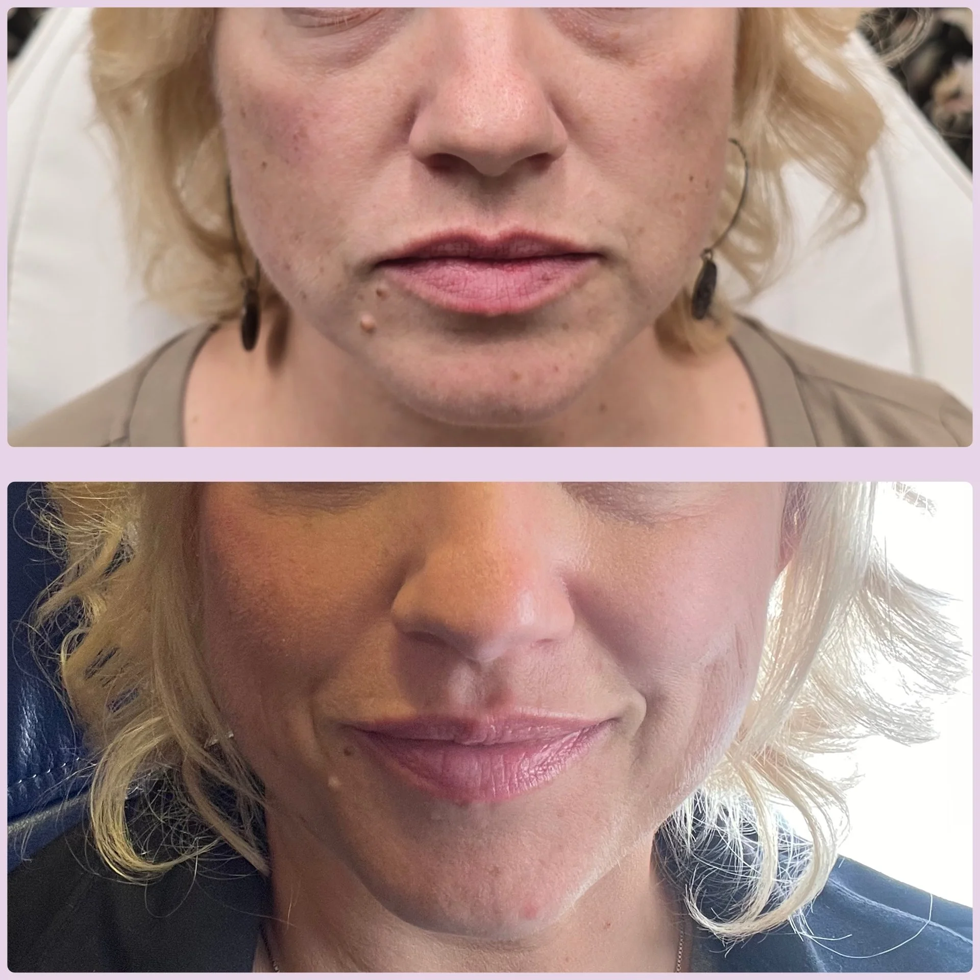 Cheek filler; undereye bag filler