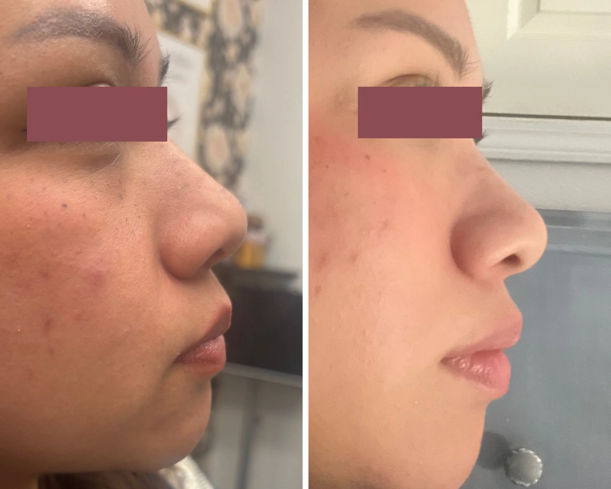 Nasal Contour with Tox
Subtle refinement of nasal movement and contour using targeted tox.