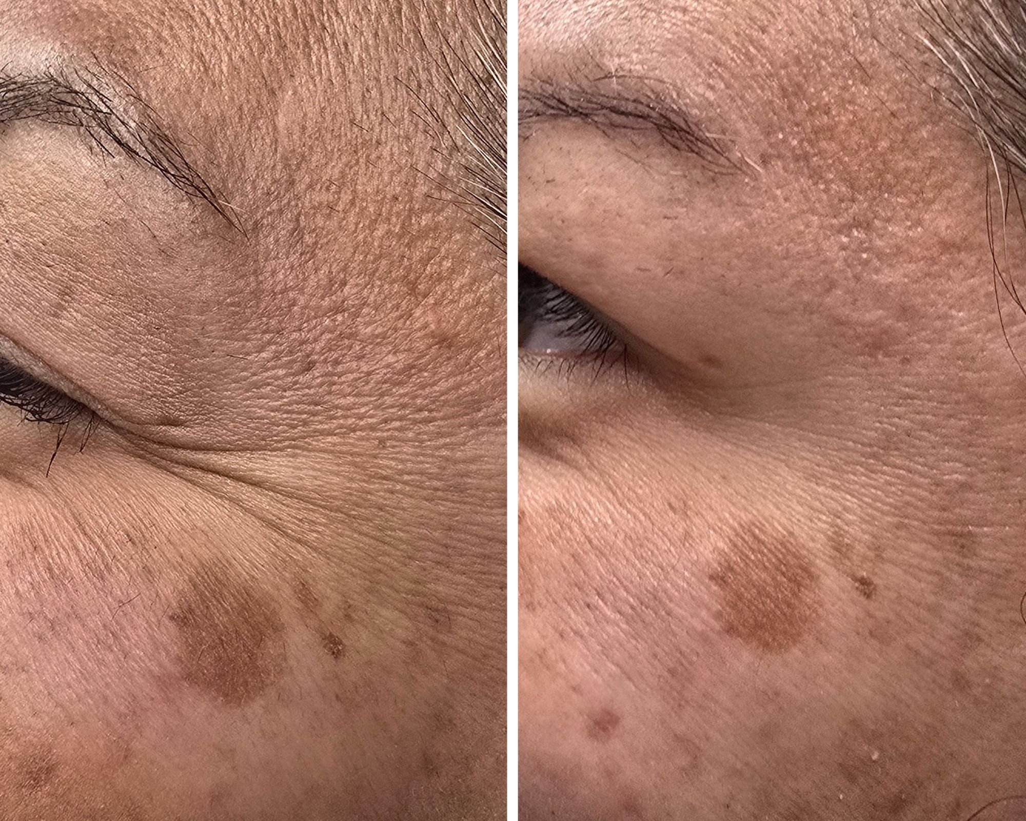 Crow's feet neurotoxin; smile lines neurotoxin