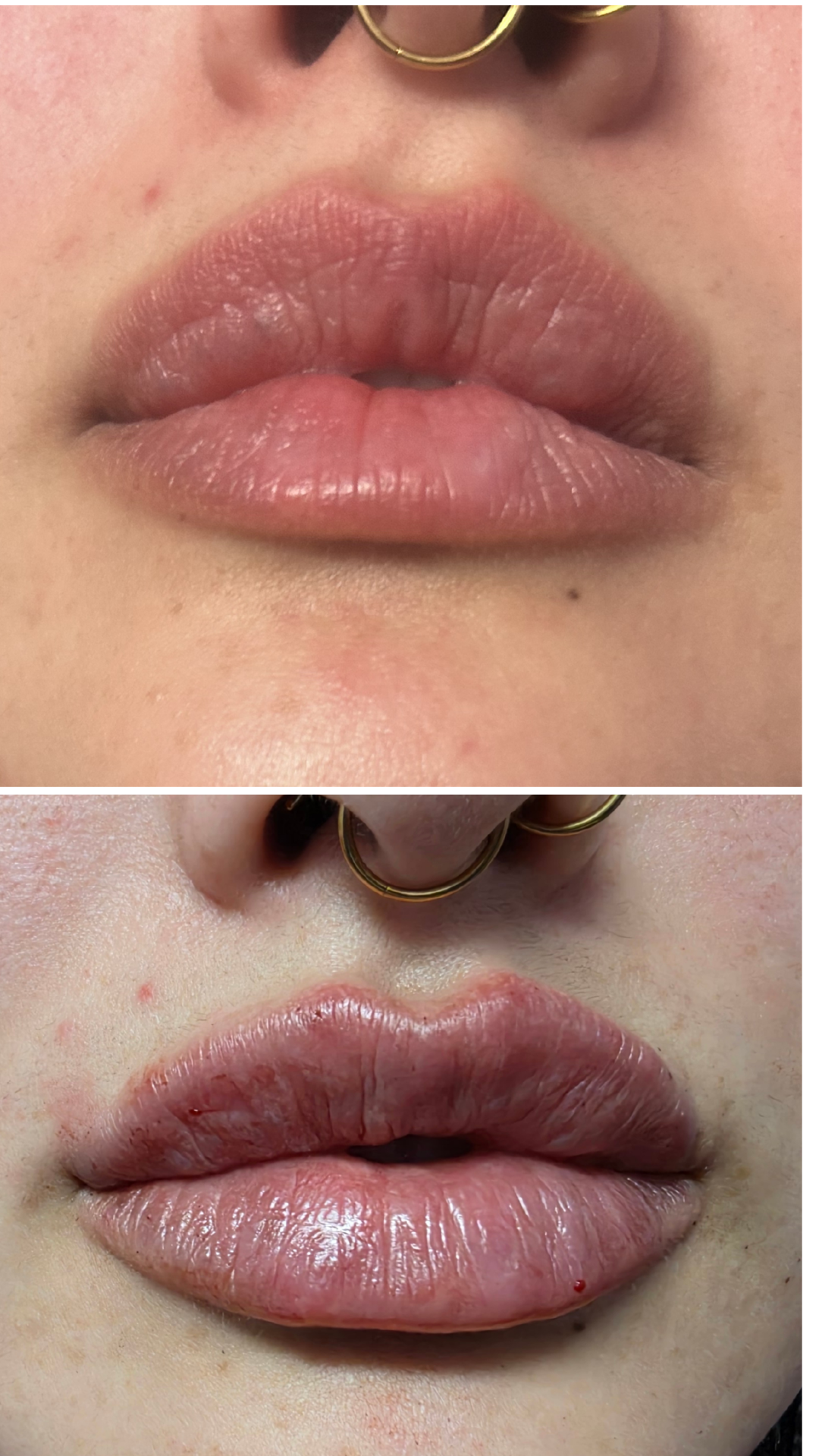 Lip Filler
Added noticeable volume for a fuller, more enhanced lip appearance with smooth contour.