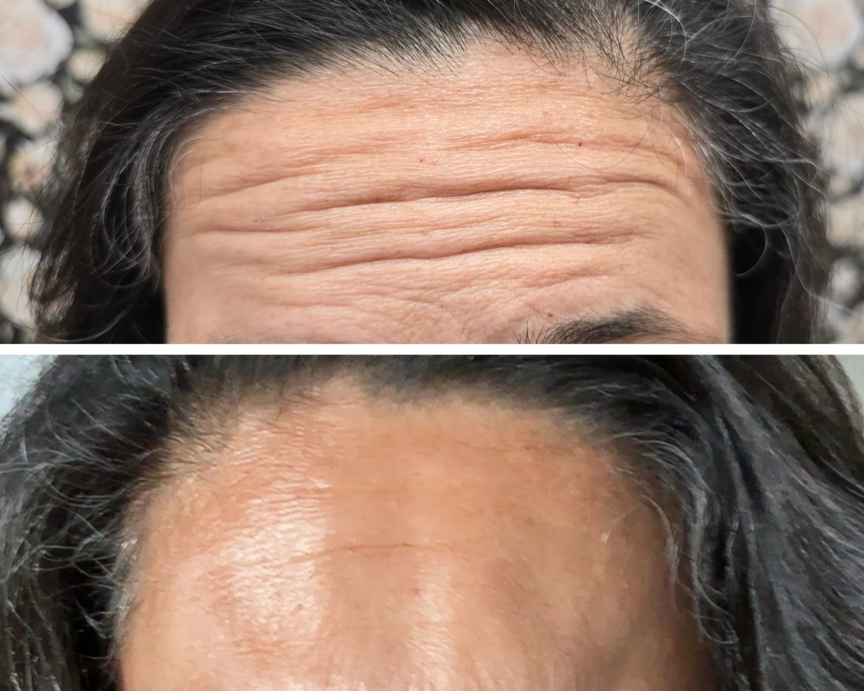 Forehead; frontalis neurotoxin