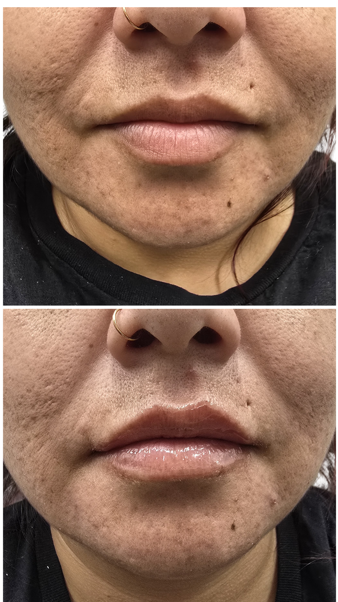 Lip Filler
Built fuller lip volume while maintaining balanced shape and soft definition.