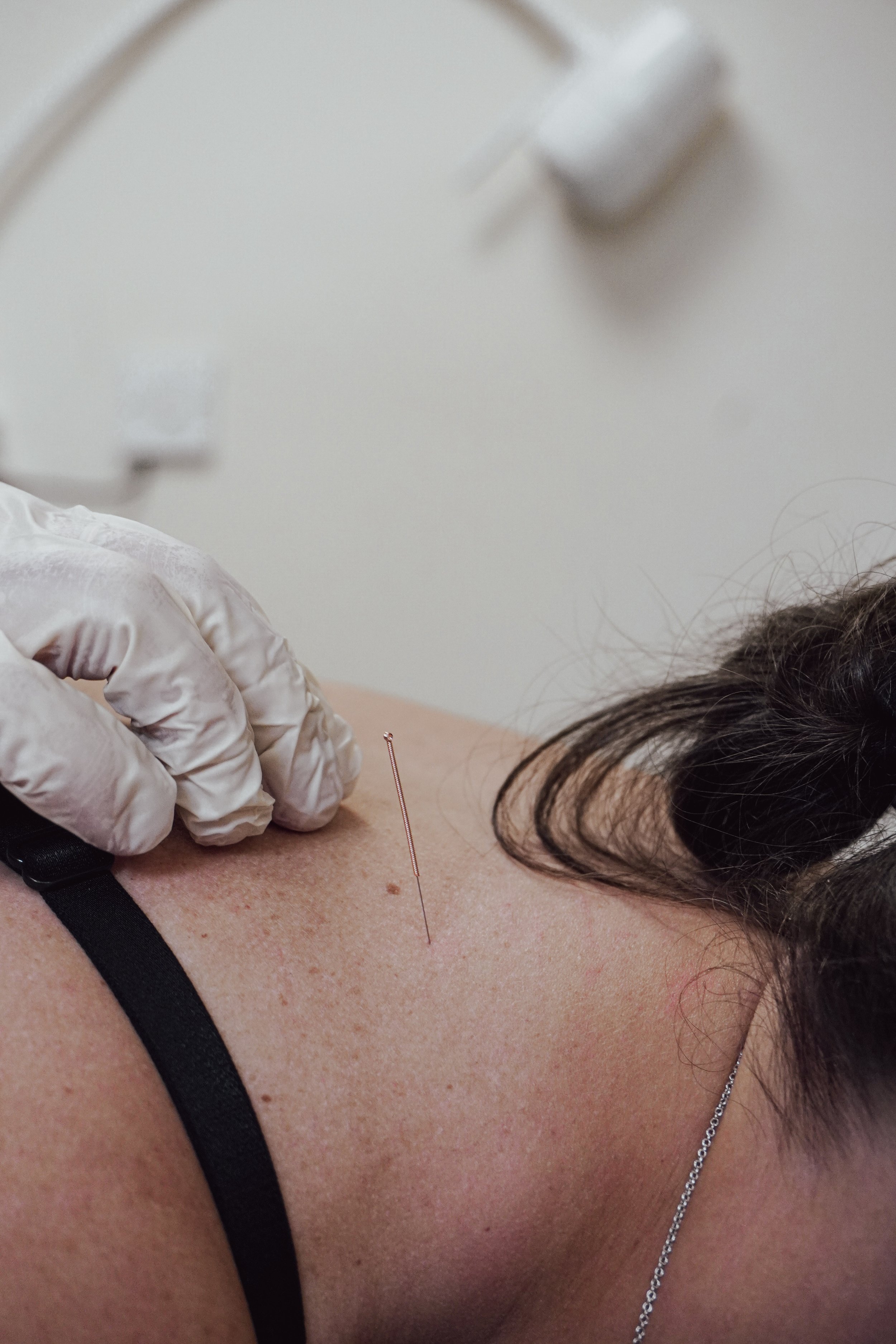 Acupuncture and dry needling treatment chiropractor chiropractic Dinas Powys and Cardiff