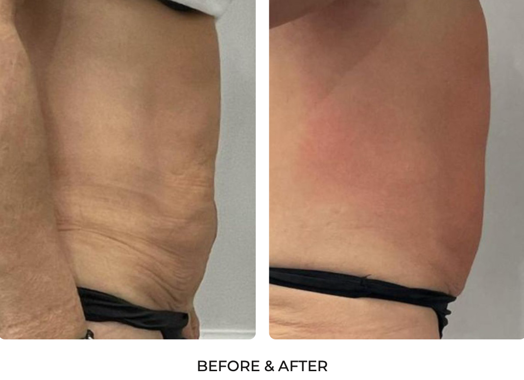 T-Shape Lower Abdomen Contouring Progress