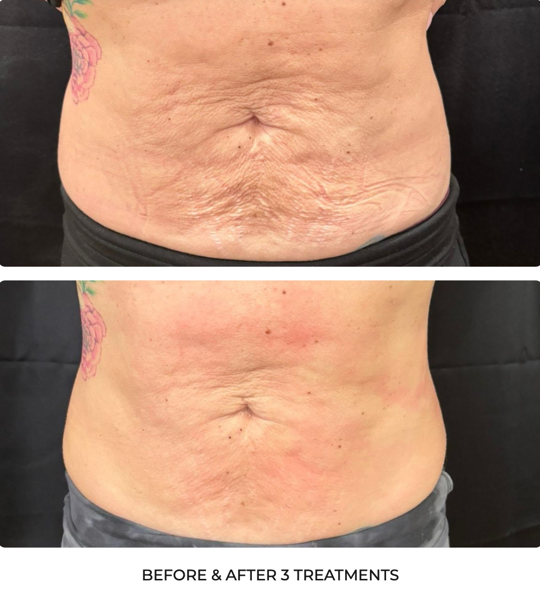 T-Shape Abdomen Skin Tightening Results