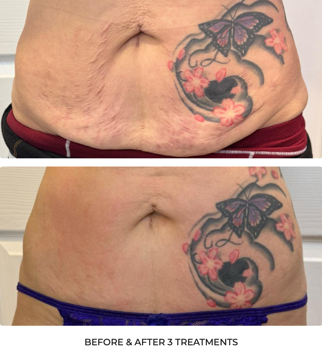 T-Shape Body Skin Firming Before and After