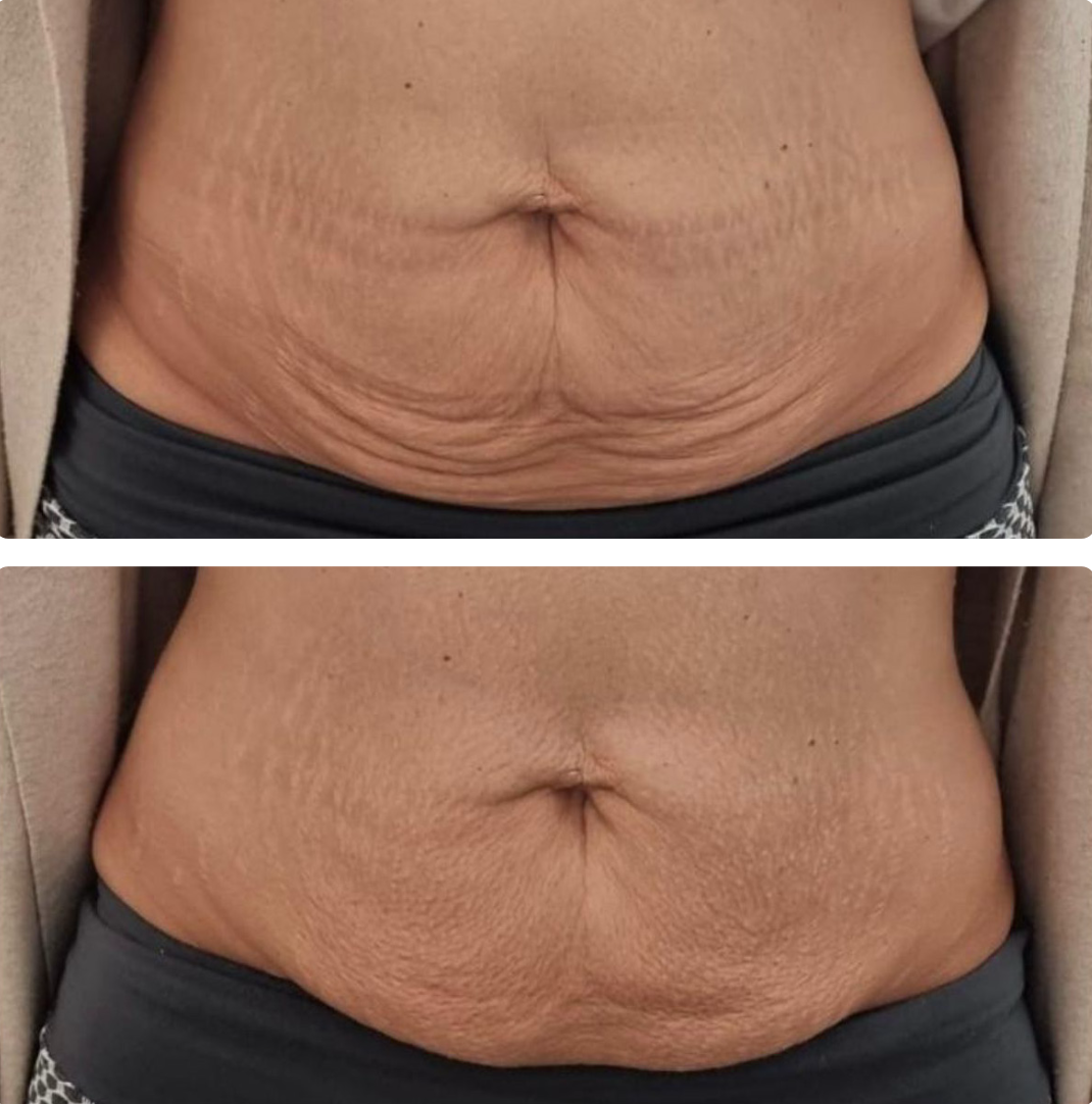 T-Shape Abdomen Skin Tightening Results