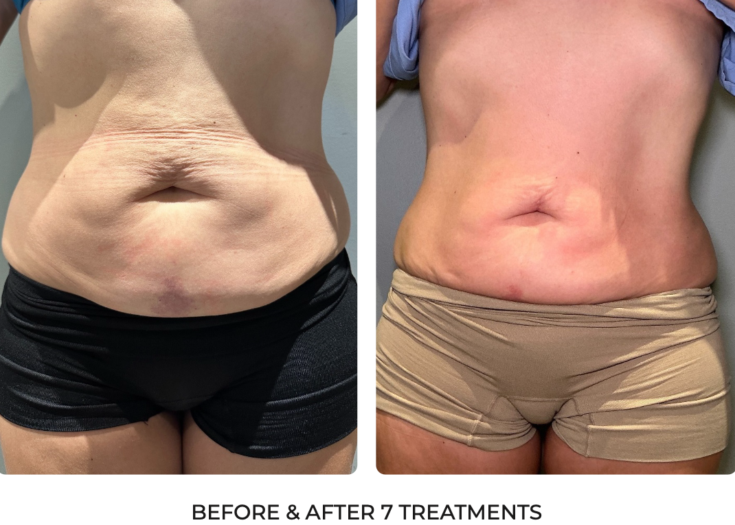 T-Shape Lower Abdomen Contouring Progress