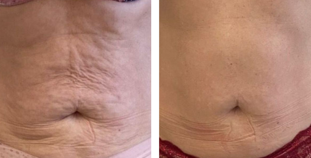 T-Shape Body Skin Firming Before and After