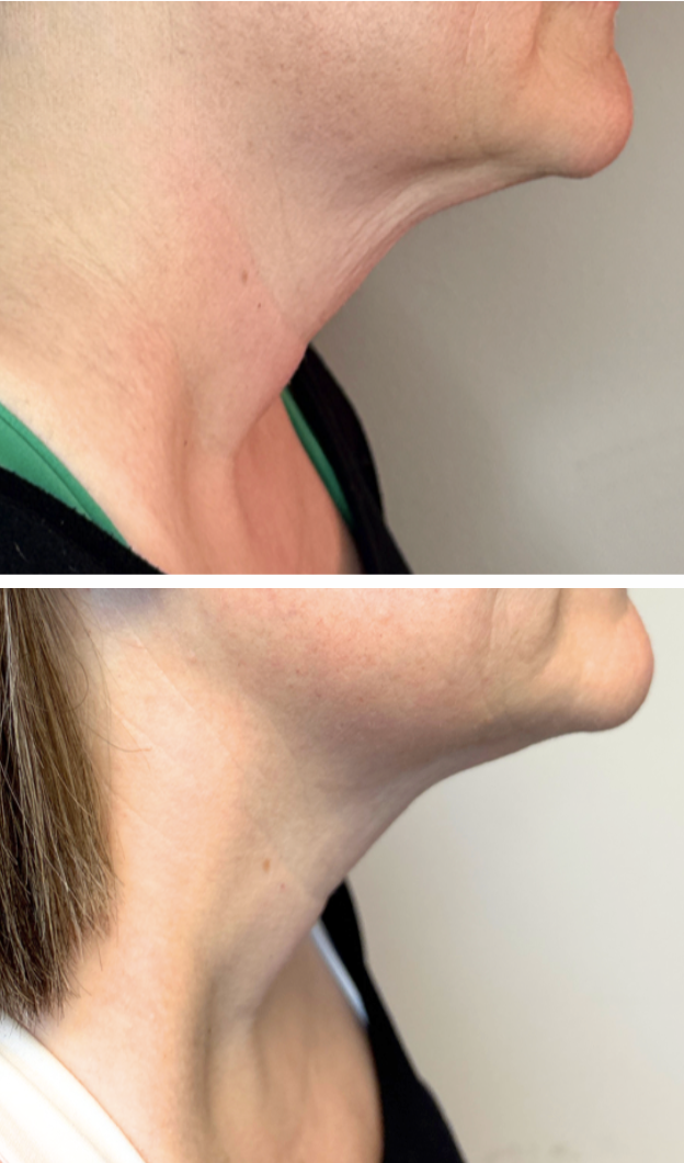 T-Shape Face and Neck Tightening Results – Eleva Glow Med Spa
