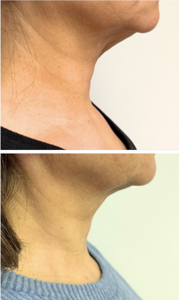 T-Shape Jawline and Neck Contouring Before and After