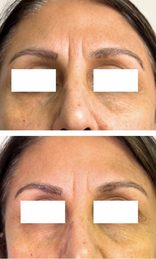 T-Shape 11 Lines Smoothing Results