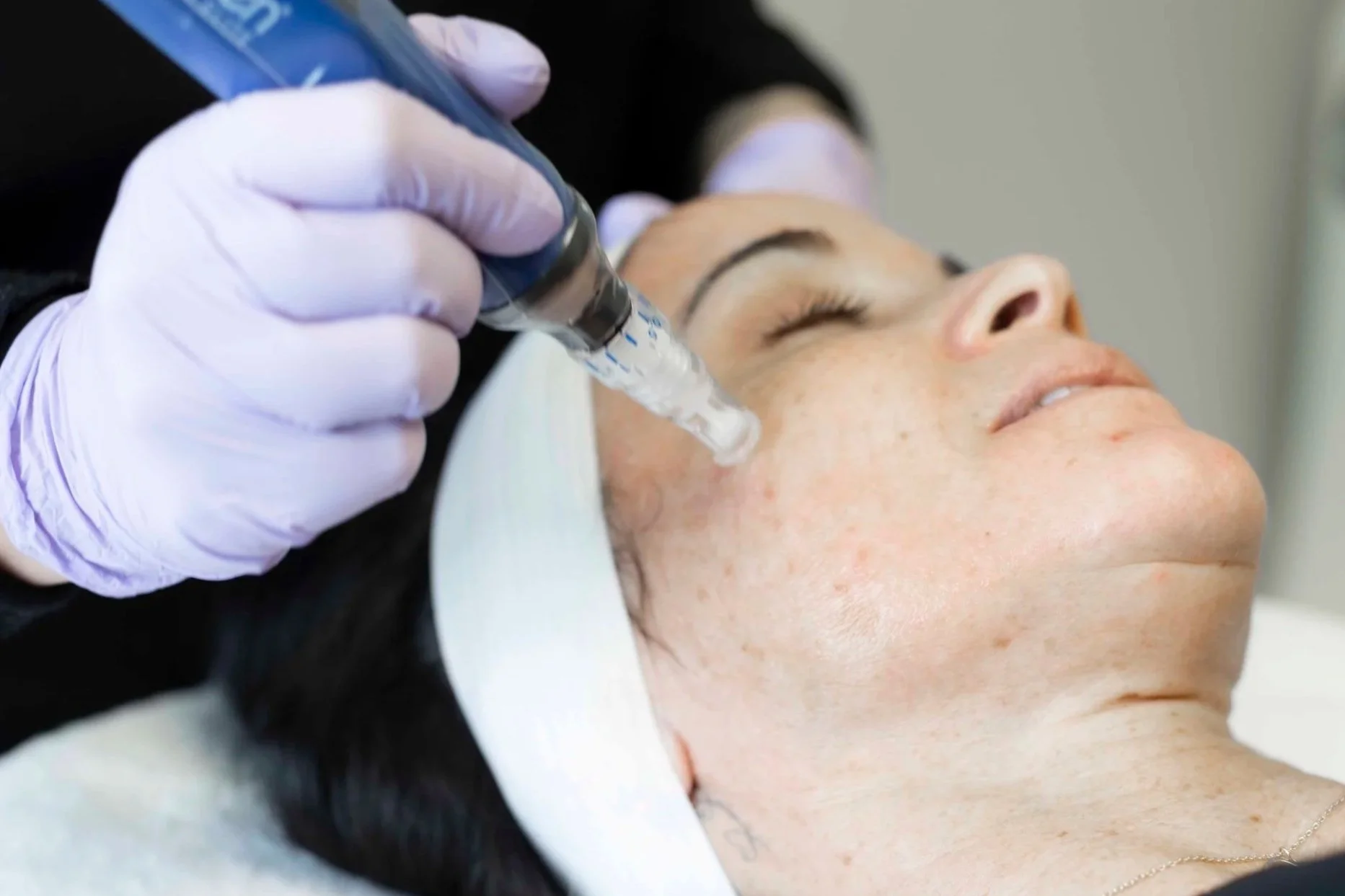 What Is Microneedling? Benefits, Results &amp; What to Expect