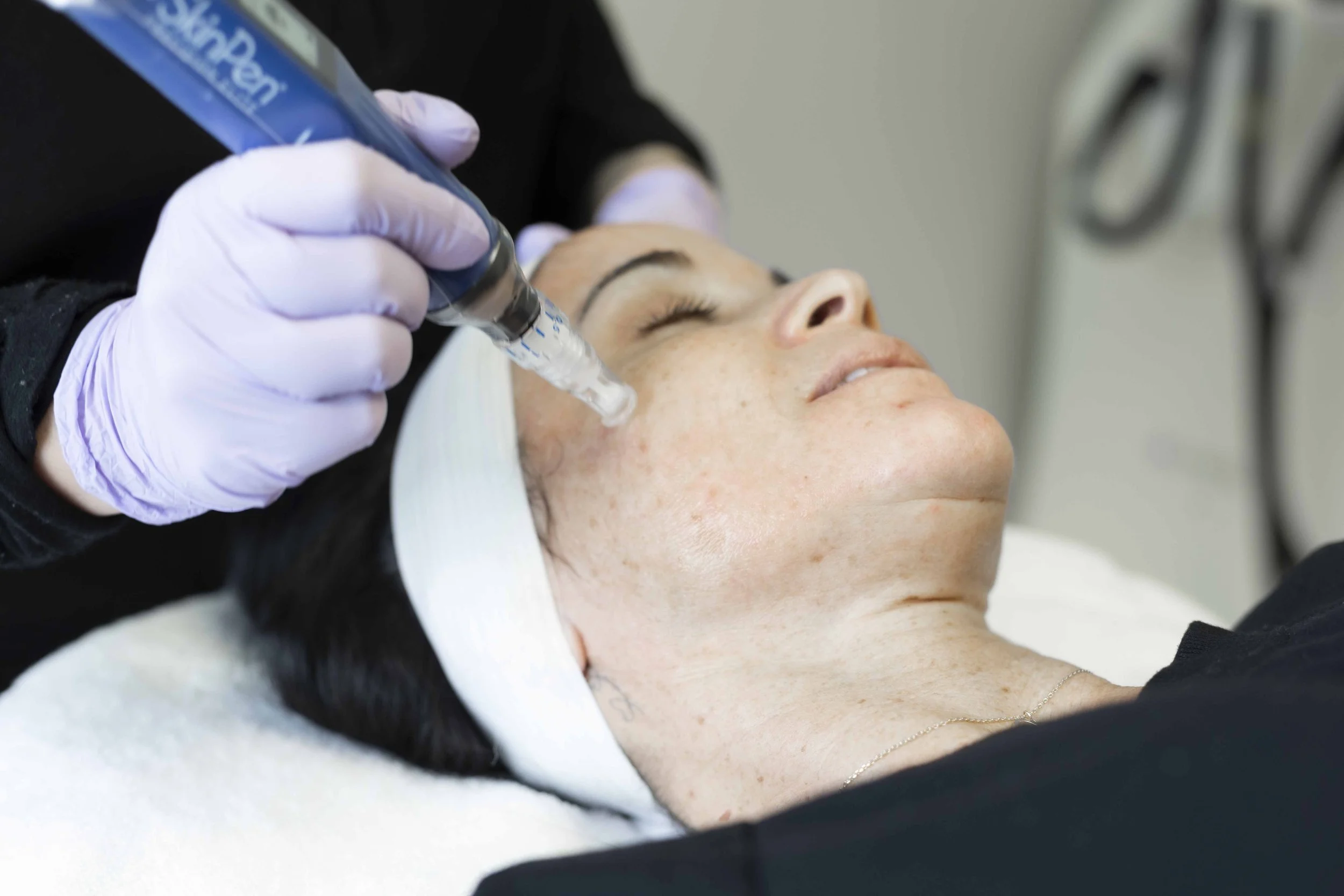 Microneedling treatment in Woodbridge VA using SkinPen at Eleva Glow Med Spa