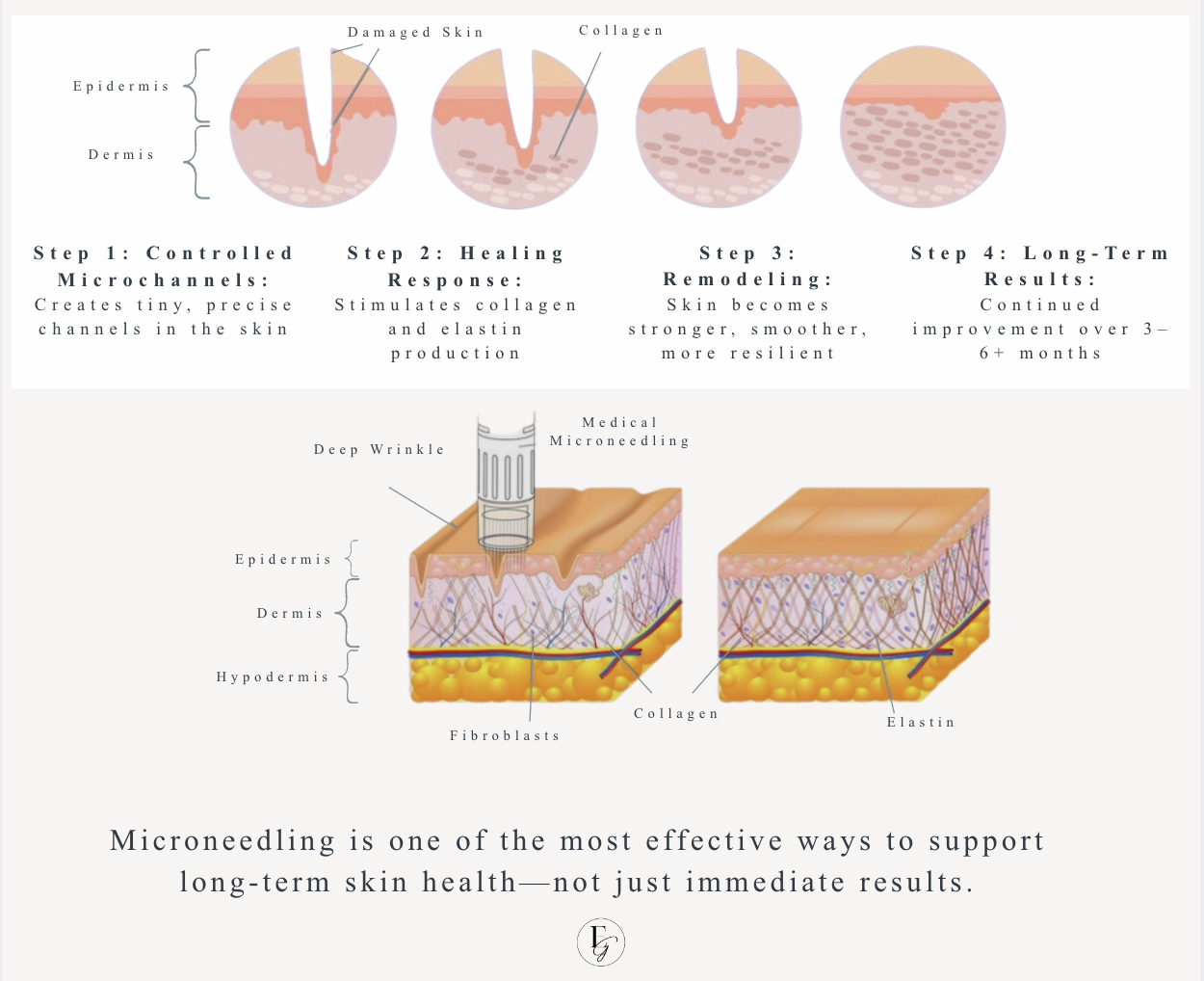 Microneedling process showing collagen stimulation and skin remodeling over time in Woodbridge VA at Eleva Glow Med Spa