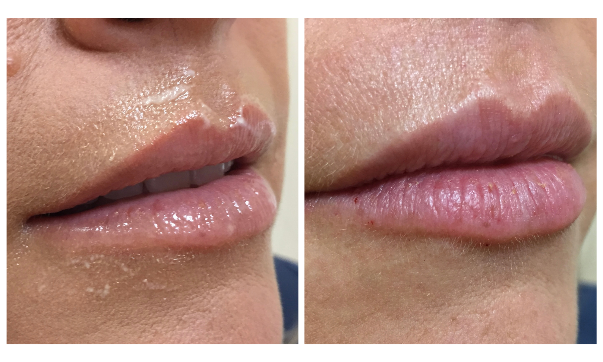 Close up before and after of patient for lip rejuvenation with Juvederm Volbella, performed by Dr. Victoria Moss, board certified dermatologist.