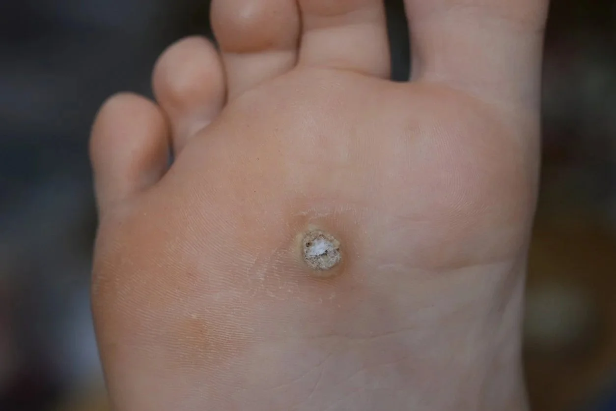 Warts Aria Dermatology Colorado Spring
