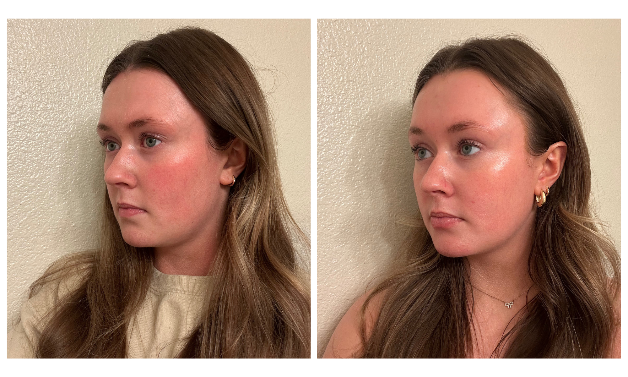 Before and after showcasing Juvederm Skinvive, showing glowing skin, performed by Dr. Victoria Moss, board certified dermatologist.