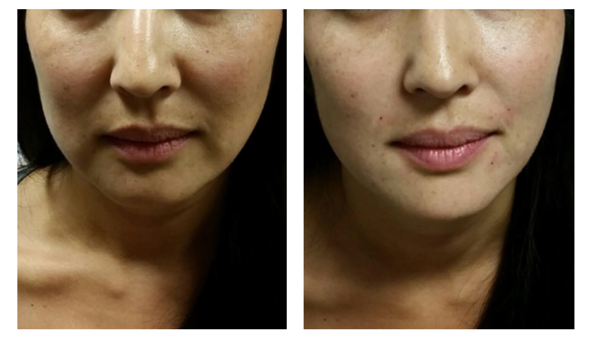 Before and after of patient for midface dermal filler improving her nasolabial folds and marionette lines, performed by Dr. Victoria Moss, board certified dermatologist.