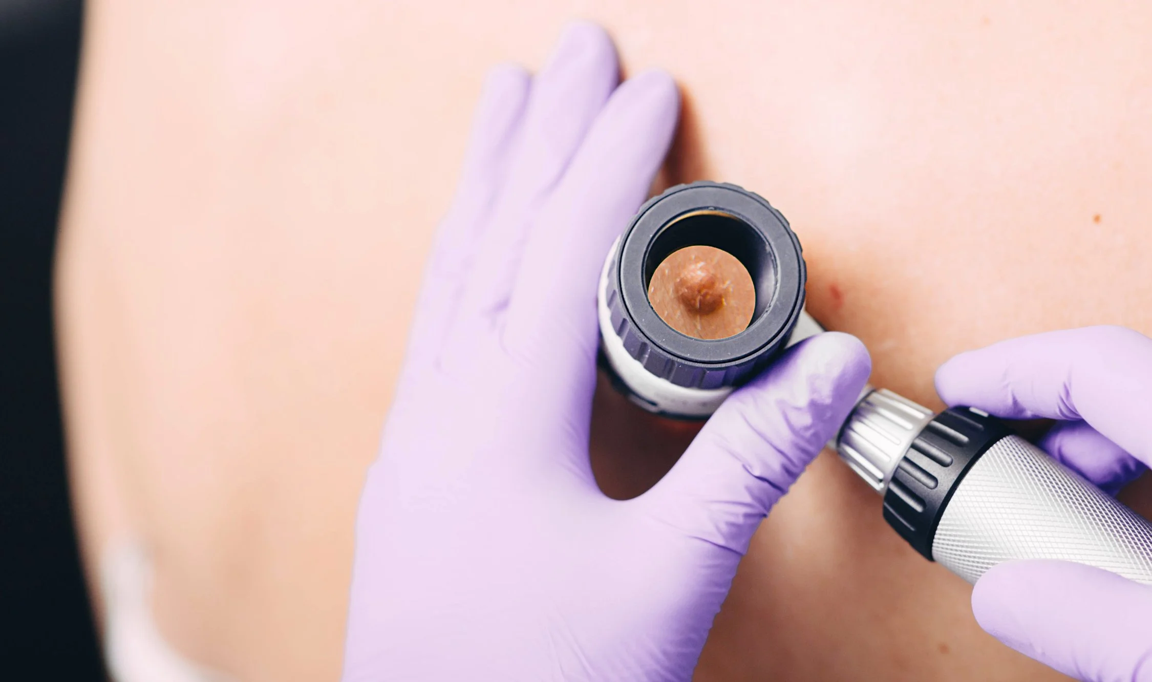Is This Mole Concerning? A Dermatologist’s Guide to When to Get Checked
