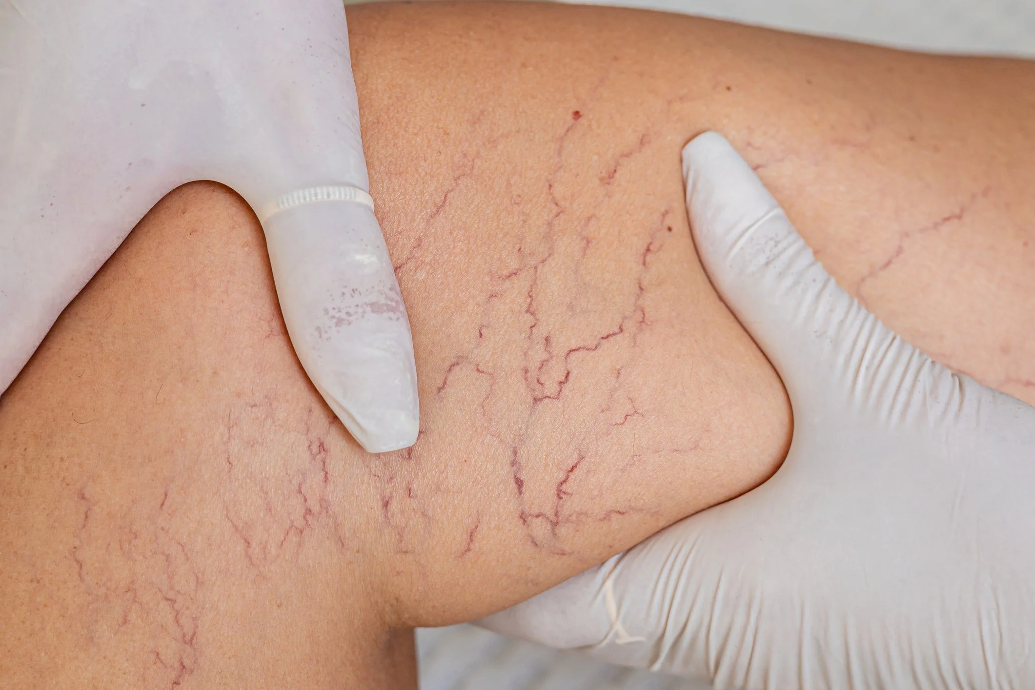 Spider Veins Sclerotherapy Victoria Moss Aria Dermatology Aesthetics Colorado Springs